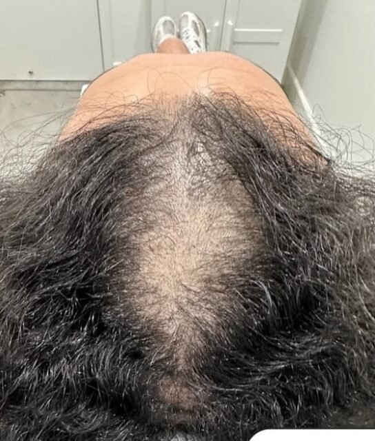 Before and after 3 PRP hair restoration , swipe to see her after results
#prp #results #hairfall#hairgoals #micronedling #skinpeels #skin#face#haircare #vitamins