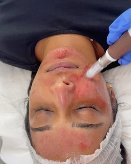 Another wonderful medical grade microneedling for this lovely client to improve her skin texture and hyperpigmentation ❤️
#hyperpigmentationtreatment #facials #micronesling #chemicalpeel #face#explore#explorepage✨ #laserhairremoval #results
