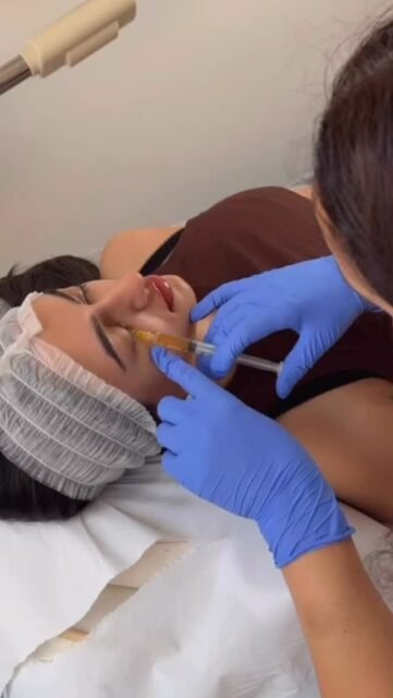 PRP for dark under eye circles
#prpeye #prpface #face#glow#healtyskin #selfcare #london#fashion #microneedling #laserhairremoval #chemicalpeels