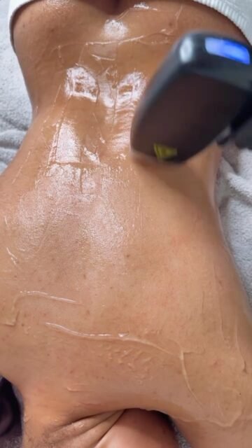 Full body laser hair removal in progress
#laserhairremoval #face #fyp#followforfollowback #facials#bodytreatment