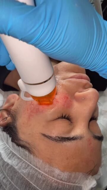 Transform your skin with the power of Microneedling RF ✨
This advanced treatment combines tiny micro-needles with radiofrequency energy to go deeper than traditional microneedling — tightening, smoothing, and reviving your skin from within. 💕
✔️ Softens fine lines & wrinkles
✔️ Reduces acne scars & large pores
✔️ Firms + lifts for a youthful glow
Ready for next-level skin? 🌟
📅 Book your Microneedling RF session today!
#MicroneedlingRF #SkinTightening #CollagenBoost #SkinRejuvenation #GlowUp