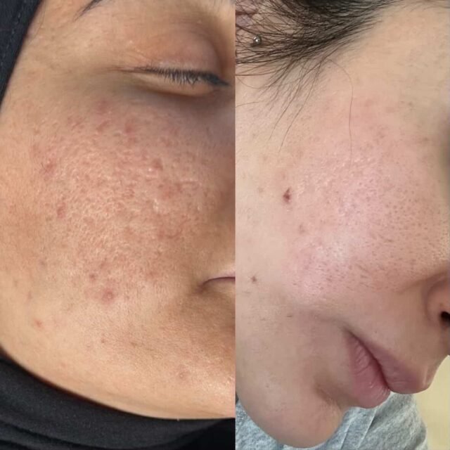 I’m so proud of my beautiful client and her skin journey! 💕
Look at her before & after — the transformation speaks for itself.
We treated her with a series of RF Microneedling sessions to target acne scars, large pores, and overall texture — and wow, what a difference! Her skin is now smoother, tighter, and glowing from within. 🌟
What made this result even more amazing?
She followed a strict home care routine exactly as recommended by us
Consistency truly pays off!
#RFMicroneedling #SkinTransformation #BeforeAndAfter #GlowingSkin #AcneScarTreatment #PoreRefining #SkinJourney #SkinGoals #CollagenBoost #ClientLove