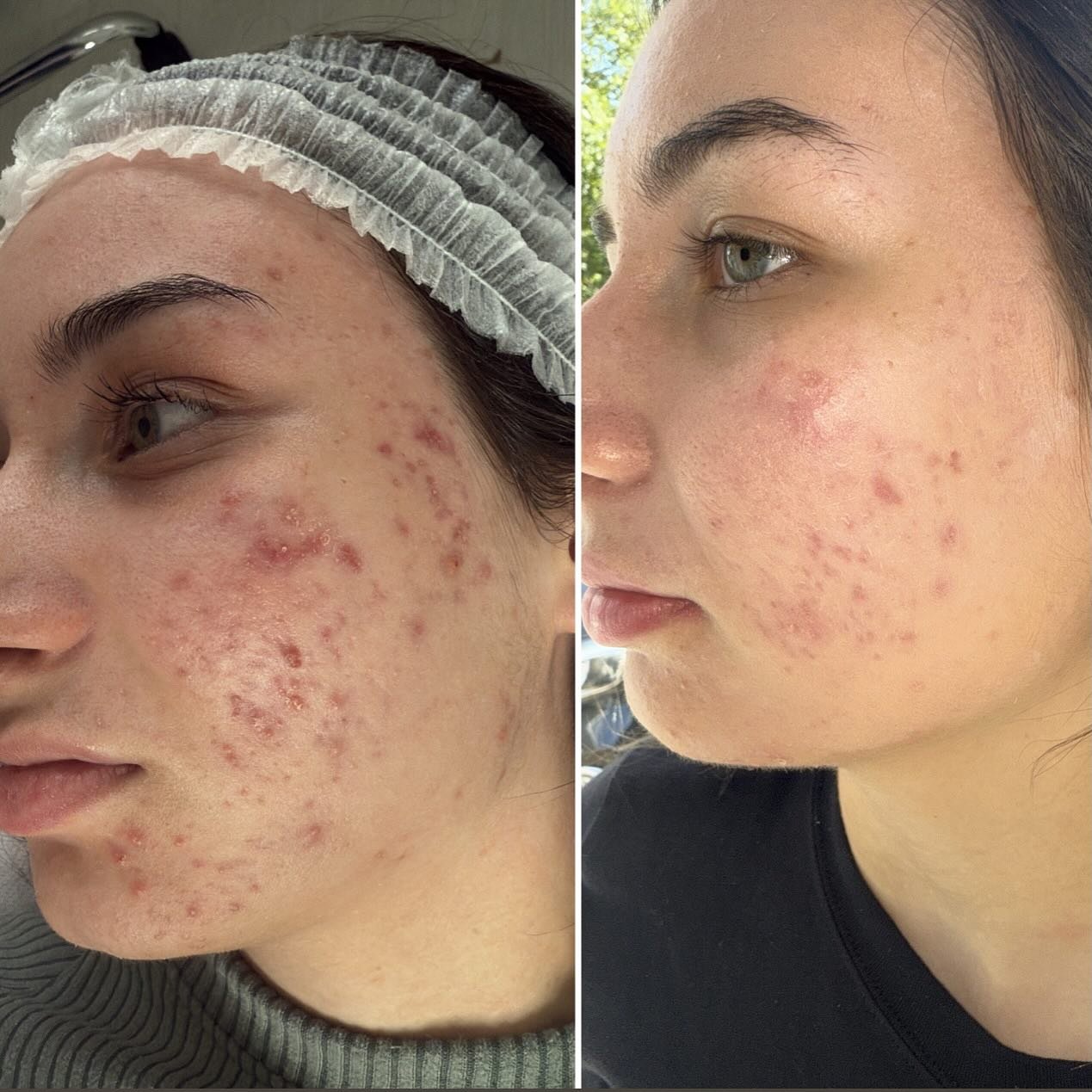 This lovely client came to me struggling with active acne and acne scarring. Together, we created a plan to target her concerns safely and effectively 🌿
She started with medium depth chemical peel treatments and few microneedling sessions , which helped calm inflammation, reduce breakouts, and improve her skin texture. Alongside this, we designed a tailored home care routine to support healing and prevent future breakouts.
The results ?
Halfway through her journey and already seeing amazing improvement. Next step: Microneedling RF to smooth and fade acne scars even more 💆♀️💫
Stay tuned ! 👀
#AcneTreatment #AcneScarTreatment #SkinTransformation #GlowingSkin #SkinCareRoutine #ClearSkinJourney #BeforeAndAfter #HealthySkin