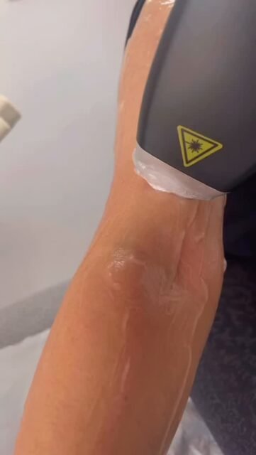 Pleasure starting this gorgeous makeup artist @heirbeauty @amreetaheir on her laser hair removal journey! 💫
Goodbye unwanted hair, hello flawless confidence 💄🌿
#LaserHairRemoval #SmoothSkin #HairFreeJourney #SkinConfidence #FlawlessSkin #GlowUp #MakeupArtistSkin #BeautyProfessionals #SelfCareRoutine #SkinGoals #HairFreeSkin #ConfidentSkin #GlowFromWithin #SkinTransformation #BeautyJourney #EffortlessBeauty