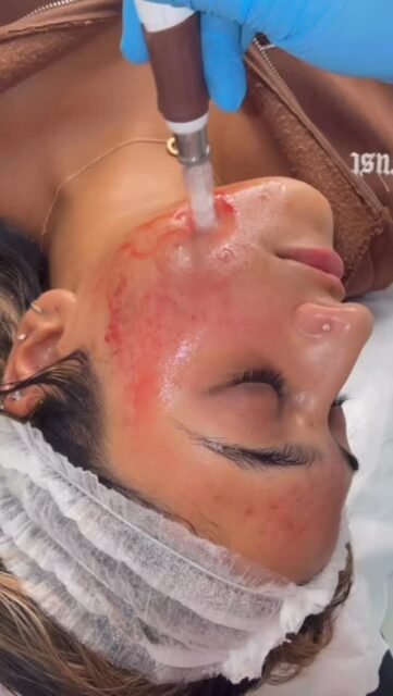 It was a pleasure treating this talented makeup artist who wanted to improve her acne scarring and achieve a smoother, more even skin texture 💫 @harneetbmua ❤️
#RFMicroneedling #AcneScarTreatment #SkinTransformation #BeforeAndAfter #GlowingSkin #CollagenBoost #MakeupArtistSkin #SmoothSkin #SkinConfidence #SkinJourney