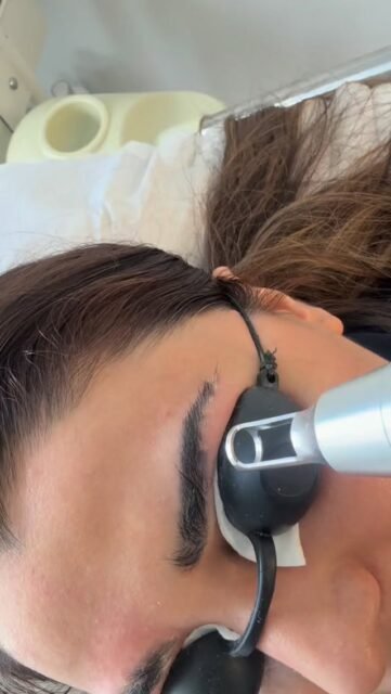 Goodbye old brows, hello fresh start! š¤
Not happy with your old eyebrow tattoo or faded permanent makeup?
Laser eyebrow tattoo removal helps break down unwanted pigment, allowing it to gradually fade over time. āØ
Whether youāre looking to correct old brow work or start fresh, every brow journey is different.
š¤ Patience is key
⨠Gradual pigment fading
š¤ A fresh start for your brows
Good results take time, and multiple sessions may be needed.
#EyebrowTattooRemoval #LaserBrowRemoval #BrowTattooRemoval #PMURemoval #browcorrections
