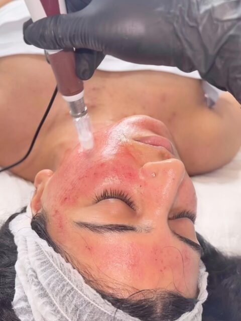 Real skin. Real progress. Real results. āØswipe to see her before and after
This didnāt happen overnight⦠š¤
Patience, consistency & trusting the process! šŖ”āØ
Microneedling helps improve skin texture, reduce the appearance of acne scars and stimulate natural collagen production.
Healthy-looking skin is a journey, not an overnight transformation. š¤
⨠Trust the process. The results are worth the patience!
#Microneedling #MicroneedlingResults #SkinTransformation #SkinJourney #AcneScars