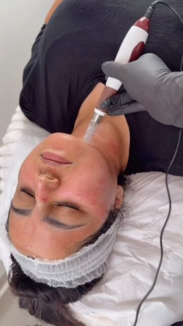 If microneedling isnāt part of your skincare routine yet⦠what are you waiting for?
Because great skin doesnāt happen overnight⦠but the right treatments can make a difference! š¤
š WHY MICRONEEDLING?
⨠Stimulates natural collagen and elastin production
⨠Helps soften fine lines and wrinkles
⨠Improves the appearance of acne scars
⨠Refines skin texture and the appearance of pores
⨠Encourages firmer, smoother, healthier-looking skin
BUT HEREāS THE BEST PART⦠š
Your microneedling treatment doesnāt end when you leave the clinic!
Thatās when your skinās natural repair and renewal process is already underway. āØ
Over the following weeks, your skin continues producing collagen and gradually rebuilding itself from within.
š¤ Your appointment is just the beginning.
š¤ Your skin continues working behind the scenes.
š¤ The results develop gradually over time.
Think of microneedling as an investment in your future skin, not just a one-day glow! āØ
Consistency, professional treatments and good aftercare are the keys to achieving your skin goals.
š© Ready to invest in your skin? DM us to book your consultation!
#Microneedling #CollagenInductionTherapy #SkinRenewal #SkinRejuvenation #GlowingSkin SkinClinic SkinConfidence